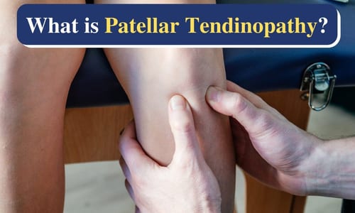 Patella tendinopathy