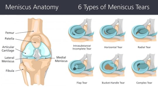 Meniscus tear