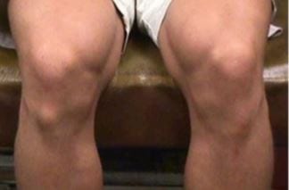 Osgood Schlatter disease