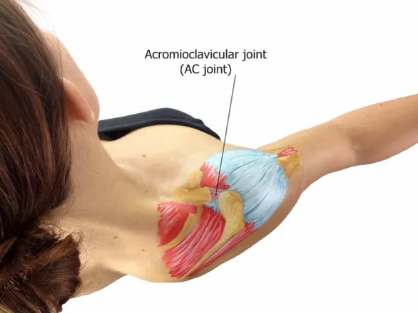 ACJ sprain treatment