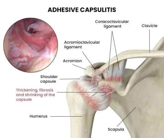 Frozen shoulder treatment