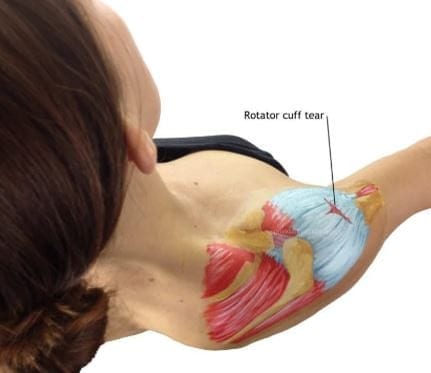 Rotator cuff tendinopathy rehabilitation