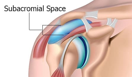 Shoulder impingement treatment