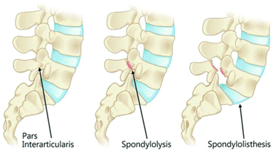 Lumbar stress fractures and pars defect management for athletes
