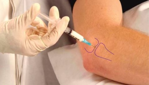 Elbow injection therapy